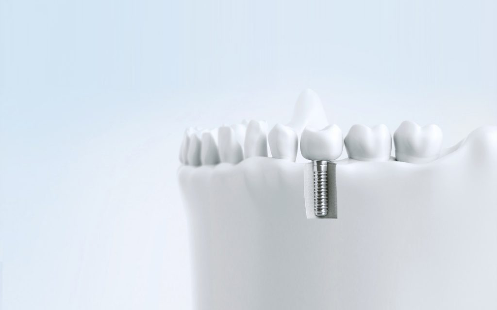 Zahnkronen und Implantate in Klagenfurt